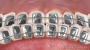 Lingual braces.