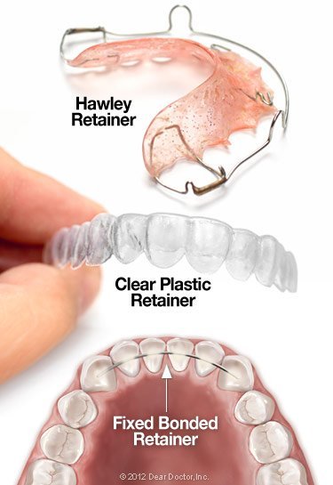 Types of orthodontic retainers.