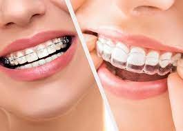 orthodontics | Dentist in Wayland, Bath, Naples, Dansville and Hornell, NY | Deborah L. Schafer, DDS